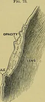 An illustration from Diseases of the eye / by Edward Nettleship ; with a supplement on examinations for color-blindness and acuity of vision and hearing, by William Thomson ; with 5 colored plates and 192 engravings. (1900)