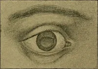 An illustration from Diseases of the eye / by Edward Nettleship ; with a supplement on examinations for color-blindness and acuity of vision and hearing, by William Thomson ; with 5 colored plates and 192 engravings. (1900)