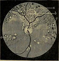 An illustration from Diseases of the eye / by Edward Nettleship ; with a supplement on examinations for color-blindness and acuity of vision and hearing, by William Thomson ; with 5 colored plates and 192 engravings. (1900)