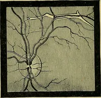 An illustration from Diseases of the eye / by Edward Nettleship ; with a supplement on examinations for color-blindness and acuity of vision and hearing, by William Thomson ; with 5 colored plates and 192 engravings. (1900)