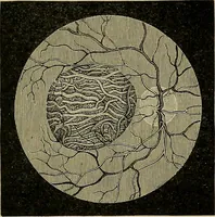 An illustration from Diseases of the eye / by Edward Nettleship ; with a supplement on examinations for color-blindness and acuity of vision and hearing, by William Thomson ; with 5 colored plates and 192 engravings. (1900)