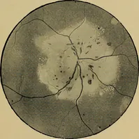 An illustration from Diseases of the eye / by Edward Nettleship ; with a supplement on examinations for color-blindness and acuity of vision and hearing, by William Thomson ; with 5 colored plates and 192 engravings. (1900)