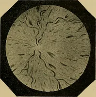 An illustration from Diseases of the eye / by Edward Nettleship ; with a supplement on examinations for color-blindness and acuity of vision and hearing, by William Thomson ; with 5 colored plates and 192 engravings. (1900)