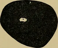 An illustration from Diseases of the eye / by Edward Nettleship ; with a supplement on examinations for color-blindness and acuity of vision and hearing, by William Thomson ; with 5 colored plates and 192 engravings. (1900)