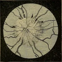 An illustration from Diseases of the eye / by Edward Nettleship ; with a supplement on examinations for color-blindness and acuity of vision and hearing, by William Thomson ; with 5 colored plates and 192 engravings. (1900)
