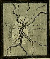 An illustration from Diseases of the eye / by Edward Nettleship ; with a supplement on examinations for color-blindness and acuity of vision and hearing, by William Thomson ; with 5 colored plates and 192 engravings. (1900)