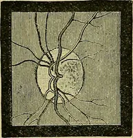 An illustration from Diseases of the eye / by Edward Nettleship ; with a supplement on examinations for color-blindness and acuity of vision and hearing, by William Thomson ; with 5 colored plates and 192 engravings. (1900)