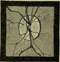 An illustration from Diseases of the eye / by Edward Nettleship ; with a supplement on examinations for color-blindness and acuity of vision and hearing, by William Thomson ; with 5 colored plates and 192 engravings. (1900)