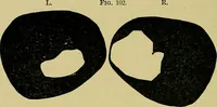 An illustration from Diseases of the eye / by Edward Nettleship ; with a supplement on examinations for color-blindness and acuity of vision and hearing, by William Thomson ; with 5 colored plates and 192 engravings. (1900)