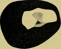 An illustration from Diseases of the eye / by Edward Nettleship ; with a supplement on examinations for color-blindness and acuity of vision and hearing, by William Thomson ; with 5 colored plates and 192 engravings. (1900)