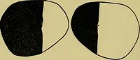 An illustration from Diseases of the eye / by Edward Nettleship ; with a supplement on examinations for color-blindness and acuity of vision and hearing, by William Thomson ; with 5 colored plates and 192 engravings. (1900)
