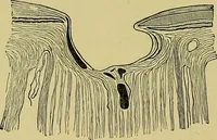 An illustration from Diseases of the eye / by Edward Nettleship ; with a supplement on examinations for color-blindness and acuity of vision and hearing, by William Thomson ; with 5 colored plates and 192 engravings. (1900)