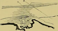 An illustration from Diseases of the eye / by Edward Nettleship ; with a supplement on examinations for color-blindness and acuity of vision and hearing, by William Thomson ; with 5 colored plates and 192 engravings. (1900)