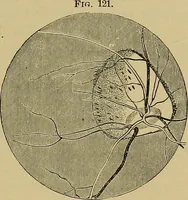 An illustration from Diseases of the eye / by Edward Nettleship ; with a supplement on examinations for color-blindness and acuity of vision and hearing, by William Thomson ; with 5 colored plates and 192 engravings. (1900)