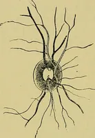 An illustration from Diseases of the eye / by Edward Nettleship ; with a supplement on examinations for color-blindness and acuity of vision and hearing, by William Thomson ; with 5 colored plates and 192 engravings. (1900)