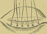 An illustration from Diseases of the eye / by Edward Nettleship ; with a supplement on examinations for color-blindness and acuity of vision and hearing, by William Thomson ; with 5 colored plates and 192 engravings. (1900)