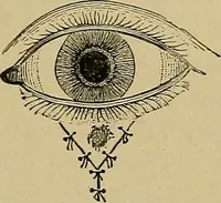 An illustration from Diseases of the eye / by Edward Nettleship ; with a supplement on examinations for color-blindness and acuity of vision and hearing, by William Thomson ; with 5 colored plates and 192 engravings. (1900)