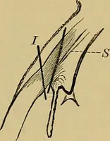 An illustration from Diseases of the eye / by Edward Nettleship ; with a supplement on examinations for color-blindness and acuity of vision and hearing, by William Thomson ; with 5 colored plates and 192 engravings. (1900)