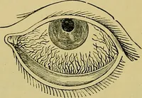 An illustration from Diseases of the eye / by Edward Nettleship ; with a supplement on examinations for color-blindness and acuity of vision and hearing, by William Thomson ; with 5 colored plates and 192 engravings. (1900)