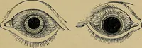 An illustration from Diseases of the eye / by Edward Nettleship ; with a supplement on examinations for color-blindness and acuity of vision and hearing, by William Thomson ; with 5 colored plates and 192 engravings. (1900)