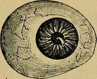 An illustration from Diseases of the eye / by Edward Nettleship ; with a supplement on examinations for color-blindness and acuity of vision and hearing, by William Thomson ; with 5 colored plates and 192 engravings. (1900)
