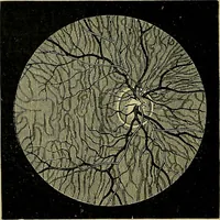 An illustration from Diseases of the eye / by Edward Nettleship ; with a supplement on examinations for color-blindness and acuity of vision and hearing, by William Thomson ; with 5 colored plates and 192 engravings. (1900)