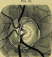 An illustration from Diseases of the eye / by Edward Nettleship ; with a supplement on examinations for color-blindness and acuity of vision and hearing, by William Thomson ; with 5 colored plates and 192 engravings. (1900)