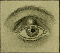 An illustration from Diseases of the eye / by Edward Nettleship ; with a supplement on examinations for color-blindness and acuity of vision and hearing, by William Thomson ; with 5 colored plates and 192 engravings. (1900)