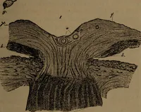 An illustration from Des altérations de l'oeil dans l'albuminurie et le diabète / par Mohammed Off ; avec planches en chromolithographie. (1870)