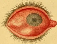 An illustration from A treatise on some practical points relating to the diseases of the eye / by the late John Cunningham Saunders ... ; to which is added, a short account of the author's life, and his method of curing the congenital cataract, by his friend and colleague J. R. Farre ; the whole illustrated by coloured engravings. (1811)