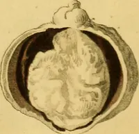 An illustration from A treatise on some practical points relating to the diseases of the eye / by the late John Cunningham Saunders ... ; to which is added, a short account of the author's life, and his method of curing the congenital cataract, by his friend and colleague J. R. Farre ; the whole illustrated by coloured engravings. (1811)