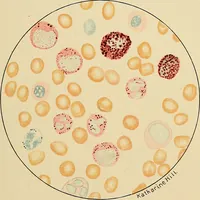 Picture 118 of 135 from Diagnostic methods, chemical, bacteriological and microscopical : a text-book for students and practitioners / by Ralph W. Webster ; with 37 colored plates and 164 other illustrations. (1909), leaf 605