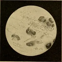 Picture 8 of 135 from Diagnostic methods, chemical, bacteriological and microscopical : a text-book for students and practitioners / by Ralph W. Webster ; with 37 colored plates and 164 other illustrations. (1909), leaf 65