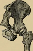 Picture 13 of 91 from Atlas and epitome of traumatic fractures and dislocations / by H. Helferich ; auth. tr. from the German, ed. by Joseph C. Bloodgood. (1902), leaf 101