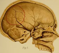 An illustration from Atlas and epitome of traumatic fractures and dislocations / by H. Helferich ; auth. tr. from the German, ed. by Joseph C. Bloodgood. (1902)