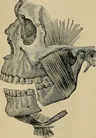 An illustration from Atlas and epitome of traumatic fractures and dislocations / by H. Helferich ; auth. tr. from the German, ed. by Joseph C. Bloodgood. (1902)