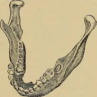 An illustration from Atlas and epitome of traumatic fractures and dislocations / by H. Helferich ; auth. tr. from the German, ed. by Joseph C. Bloodgood. (1902)