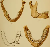 An illustration from Atlas and epitome of traumatic fractures and dislocations / by H. Helferich ; auth. tr. from the German, ed. by Joseph C. Bloodgood. (1902)