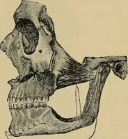 An illustration from Atlas and epitome of traumatic fractures and dislocations / by H. Helferich ; auth. tr. from the German, ed. by Joseph C. Bloodgood. (1902)
