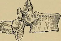 Picture 23 of 91 from Atlas and epitome of traumatic fractures and dislocations / by H. Helferich ; auth. tr. from the German, ed. by Joseph C. Bloodgood. (1902), leaf 163