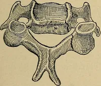 An illustration from Atlas and epitome of traumatic fractures and dislocations / by H. Helferich ; auth. tr. from the German, ed. by Joseph C. Bloodgood. (1902)