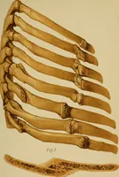 An illustration from Atlas and epitome of traumatic fractures and dislocations / by H. Helferich ; auth. tr. from the German, ed. by Joseph C. Bloodgood. (1902)
