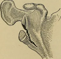An illustration from Atlas and epitome of traumatic fractures and dislocations / by H. Helferich ; auth. tr. from the German, ed. by Joseph C. Bloodgood. (1902)