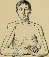 An illustration from Atlas and epitome of traumatic fractures and dislocations / by H. Helferich ; auth. tr. from the German, ed. by Joseph C. Bloodgood. (1902)