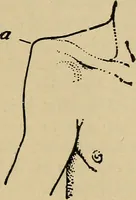An illustration from Atlas and epitome of traumatic fractures and dislocations / by H. Helferich ; auth. tr. from the German, ed. by Joseph C. Bloodgood. (1902)