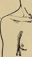 An illustration from Atlas and epitome of traumatic fractures and dislocations / by H. Helferich ; auth. tr. from the German, ed. by Joseph C. Bloodgood. (1902)