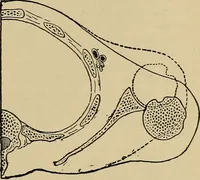 An illustration from Atlas and epitome of traumatic fractures and dislocations / by H. Helferich ; auth. tr. from the German, ed. by Joseph C. Bloodgood. (1902)