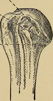 An illustration from Atlas and epitome of traumatic fractures and dislocations / by H. Helferich ; auth. tr. from the German, ed. by Joseph C. Bloodgood. (1902)