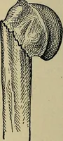 An illustration from Atlas and epitome of traumatic fractures and dislocations / by H. Helferich ; auth. tr. from the German, ed. by Joseph C. Bloodgood. (1902)