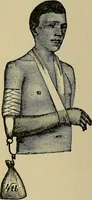 An illustration from Atlas and epitome of traumatic fractures and dislocations / by H. Helferich ; auth. tr. from the German, ed. by Joseph C. Bloodgood. (1902)